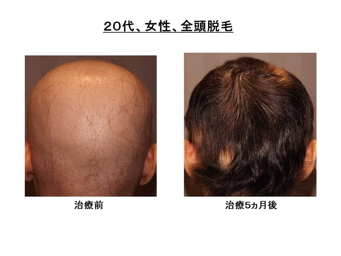 円形脱毛症　病院""